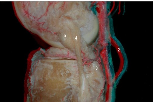 Figure 9 Lateral view of the posterolateral compartment of the knee: the pathway of the lateral inferior genicular artery and the relationship with other structures of the posterolateral compartment: popliteofibular ligament (3), lateral collateral ligament (4), and popliteus tendon (5). Popliteal artery (1) and inferior medial genicular artery (2).