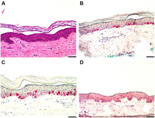 Figure 2 Lentigo with focal junctional melanocytic hyperplasia. (A) H&E stain, (B) HMB-45 stain, (C) Melan-A stain, (D) SOX-10 stain. Melan-A and SOX-10 showed increased staining at the dermo-epidermal junction. Scale bar = 50 µm.