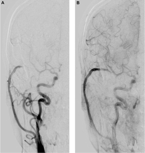 Figure 4 (A) Follow-up right carotid angiogram performed 1 year after the surgery reveals that the ipsilateral middle cerebral artery area is supplied by anterograde filling via the internal carotid artery during the arterial early phase of angiography. (B) During the arterial late phase, retrograde filling via the patent high-flow bypass is shown.