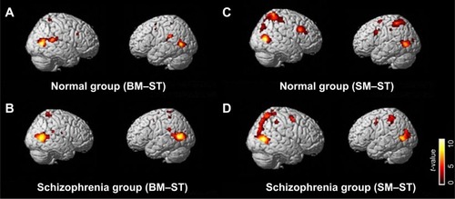 Figure 2 Brain regions significantly activated in the BM–ST (A, B) and SM–ST (C, D) conditions have been superimposed onto the SPM templates.