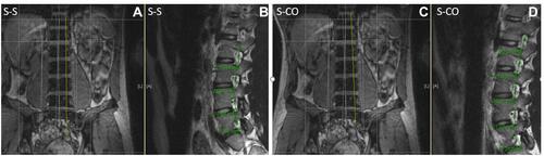 Figure 13 S-S vs S-CO demonstrating CO slices with less consistent NF caliber in this normal individual. 13A demonstrates false NF height (B) when standard coronal oblique line (yellow) is not commensurate with endplate taper (A). (D) demonstrates true NF height in all visualized NF when coronal oblique slice is performed (C).