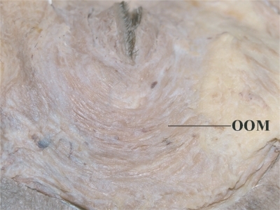 Figure 1 Macroscopical examination (left: cephalad, bottom: lateral). The lateral palpebral raphe is not identified in the lateral part of the orbicularis oculi muscle. The superior and inferior orbicularis oculi muscles were continuous without any tendinous intercalation between them. Central white tissue on the preseptal orbicularis oculi muscle is fascia.