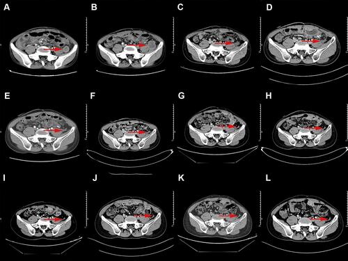 Figure 1 Abdomen CT scans showed the metastatic lesions on mesentery (red arrows for the target lesion). (A) June 23, 2016; (B) September 20, 2016; (C) January 3, 2017; (D) March 21, 2017; (E) June 27, 2017; (F) September 26, 2017; (G) May 5, 2018; (H) December 4, 2018; (I) April 1, 2019; (J) October 15, 2019; (K) March 30, 2020; (L) August 29, 2020.