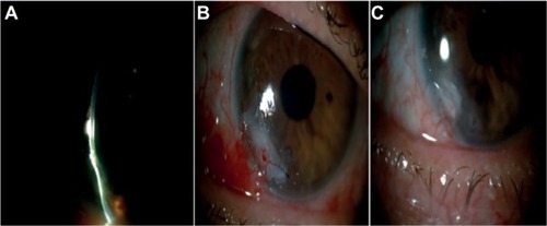 Figure 3 Photographs showing one of the cases (patient #3) with an epithelial and stromal ulcer defect in the left eye.