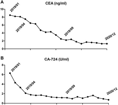 Figure 4 Cancer CEA (ng/mL) and CA-724 (U/mL) levels of the patient. (A) CEA levels during entire treatment. (B) CA-724 levels during entire treatment.