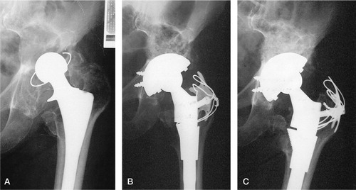 Figure 1. Incorporation of graft. A) Preoperative view of left hip in an 86-year-old female, 8 years after primary hip replacement. B) Immediate postoperative view following reconstruction with Surgibone and autograft under PFC cup (DePuy, Warsaw, IN) and SROM stem (DePuy). C) Appearance of graft at 3 months, showing partial incorporation.