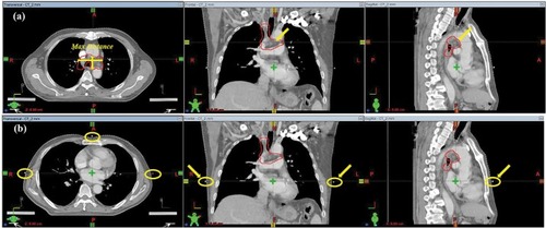 Figure 1 Selection of the initial layer, when reconstructing 3D images with slice thickness of 4, 6, 8, and 10 mm.Notes: (A) Internal tumor information method; the layer showing the largest section through the target; (B) external CT Reference markers method; the layer showing three metal markers.Abbreviation: CT, computed tomography.