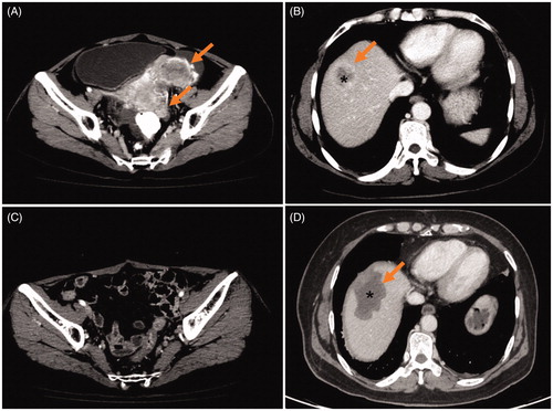Figure 2. A 55-year-old woman with solitary ovarian cancer liver metastasis (OCLM). (A) Contrast-enhanced CT shows ovarian cancer (OC) lesions (arrow) located on left ovary in the arterial phase; (B) Contrast-enhanced CT shows OCLM lesion (*, arrow) located on S6 in liver; (C) Contrast-enhanced CT shows OC lesions removed by cytoreductive surgery (CRS) after 1 month (arrow); (D) Contrast-enhanced CT shows OCLM lesion (*, arrow) underwent surgical resection after 4 months.