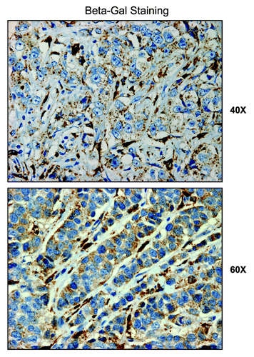 Figure 13. β-galactosidase is predominantly expressed in the tumor stroma of human breast cancer patients. We investigated the compartmentalization of β-galactosidase in a panel of human breast cancer samples, using specific-antibodies directed against β-galactosidase. Note that β-galactosidase is largely confined to the tumor stroma. Thus, expression of β-galactosidase in vivo may be a stromal phenomenon, reflecting the onset of senescence in the tumor microenvironment.