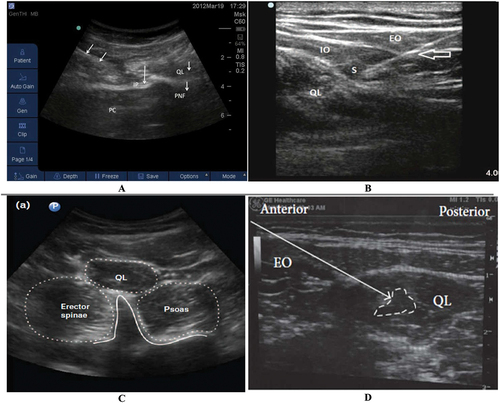 Figure 1. Ultrasound images of A) lateral QLB, arrows in upper left corner indicating needle shaft approaching in a medial to lateral-posterior direction towards the injection point (IP). B) posterior QLB, arrow indicates needle, which pierces through internal oblique (IO) and external oblique (EO) in its path to the posterior border of the QL. C) shamrock sign. D) intramuscular QLB, white arrow: needle trajectory, and white dotted line: spread of local anesthetic.PC: Peritoneal cavity, IP: Injection point, QL: Quadratus lumborum muscle, PNF: Peri nephric fat, (S) local anesthetic solution