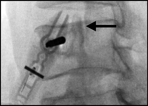 Figure 6 Oblique view of lumbar vertebrae with squared off endplates and facet centered at the midpoint of the vertebrae (arrow).