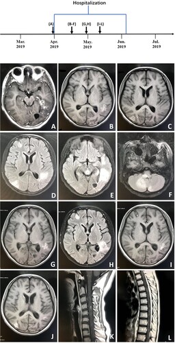 Figure 6. A, Axial T1-weighted enhanced image (March 28, 2019) showing multiple enhanced lesions throughout the brain, including the parietal lobe, left temporal lobe and occipital, and cerebellum. B, C, Axial T1-weighted images (April 13, 2019). D–F, Axial T2-weighted images (tirm dark fluid) (April 13, 2019) showing larger areas of multiple enhanced nodular lesions. G, Axial T1-weighted image (April 26, 2019). H, Axial T2-weighted image (tirm dark fluid) (April 26, 2019) showing new patchy lesions in the right frontal region. I–L, T1-weighted images (May 8, 2019) of the spinal cord and head showing new patchy lesions in the cervical and thoracic regions.