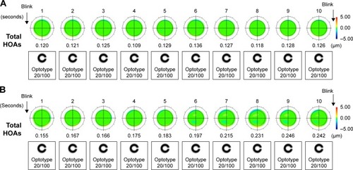 Figure 2 Sequential wavefront color-coded maps of total ocular HOAs in a control subject and a representative patient with a history of chalazion.