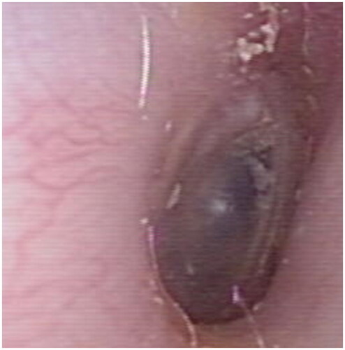 Figure 1. Image of right tympanic membrane. Cone of light is slightly weakened.