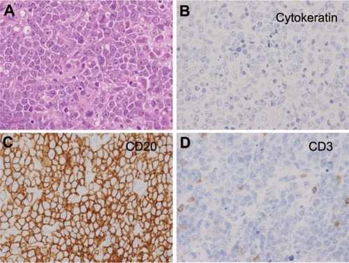 Figure 3 Histopathological examination of paranasal-sinuses tumor of Case 2. (400×) (A) Atypical cells with anisonucleosis, aberrant chromatin, and dyskaryosis. Giemsa stain. Immunocytochemical findings. The cells are negative for T-lymphocyte surface antigen (CD3). (B) Immunocytochemical findings. The cells are negative for cytokeratin (AE1/AE3), a marker of epithelial cells. (C) Immunocytochemical findings. The cells are positive for B-lymphocyte surface antigen (CD20). (D) Immunocytochemical findings. The cells are negative for T-lymphocyte surface antigen (CD3).