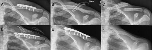 Figure 3 Refracture; (A) axial radiograph following initial surgical treatment of an Allman type 1 fracture without defect augmentation; (B) axial radiograph following implant removal; (C) axial radiograph of the refracture following implant removal; (D) post-operative axial radiograph after ORIF and defect/implant augmentation, (E) axial radiograph at 12 months revealing excellent radiographic union; and (F) axial radiograph upon implant removal at 18 months.