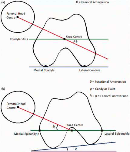 Figure 1. Measurement of femoral anteversion and the effect of condylar twist angle. (a) Measurement of femoral anteversion – angle between the condylar axis (green) and the femoral neck axis (red) [25]. (b) The condylar twist angle, caused by the posterior projection of the medial femoral condyle being greater than that of the lateral condyle, which externally rotates the transepicondylar axis of the femur [28].