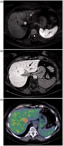 Figure 2. Axial diffusion-weighted MRI (a), contrast-enhanced MRI, hepato-biliary phase (b), and 5-HTP PET/CT (c) in the same patient. The larger lesion is clearly visible in all three, but the smaller one (indicated with arrow in MR images) is difficult to separate from the background uptake on the PET/CT image.