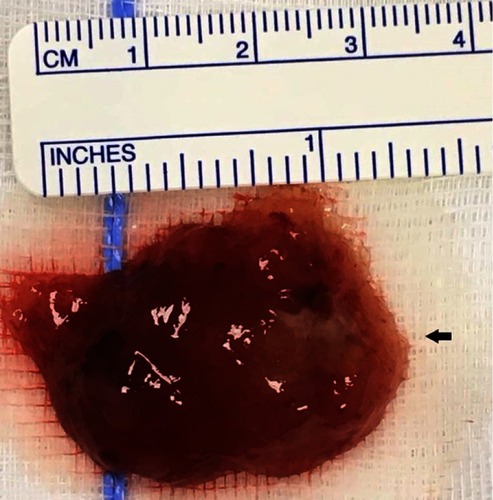 Figure 3 Resected gross specimen. Histopathology examination of the specimen confirmed the diagnosis of myxoma.