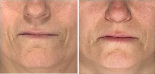 Figure 4 Patient at baseline (left) and Week 12 after receiving three SP-HA injections in the face (right).