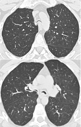 Figure 3 MDCT with thin collimation acquisition during a forced continuous expiratory maneuver (dynamic expiratory CT) in a patient with tracheobronchomalacia. The lumen of the trachea and the proximal bronchi are almost completely collapsed. Note the anterior displacement of the posterior wall of the airway towards the anterior wall.