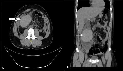 Figure 1 Contrast-enhanced computed tomography (CECT) abdomen showing intramural hematoma (arrow) of ascending colon. (A) Coronal view and (B) sagittal view.