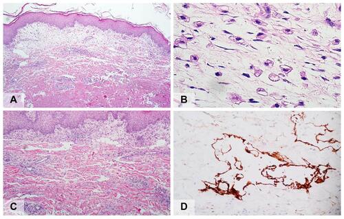 Figure 2 (A) Histopathology shows perivascular and interstitial inflammatory cell infiltration, predominantly in the markedly edematous papillary dermis (hematoxylin-eosin, original magnification x20); (B) Edema-phages, swelling or ballooning of histiocytes, containing either small or large clear vacuoles in their cytoplasm (hematoxylin-eosin, original magnification x400); (C) Numerous, large, irregular, thin-walled vascular channels lined by a single layer of flattened endothelial cells (hematoxylin-eosin, original magnification x40); (D) Immunohistochemistry reveals positive staining of the ectatic vessel endothelial cells with D2-40 (podoplanin) (original magnification x400).