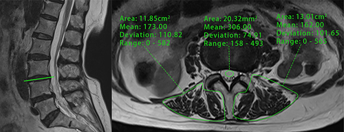 Figure 2 A 75-year-old woman with MRI t2-weighted images suggestive of severe muscle atrophy and more fatty infiltration of the paravertebral muscles had the signal intensity (SI) of the right and left paravertebral muscles and cerebrospinal fluid measured separately at the L3/4 disc level.