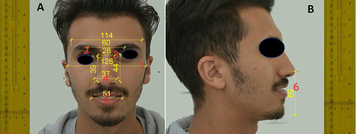 Figure 2 Parameters in facial measurements for frontal view (A) and lateral view (B).