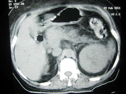 Figure 1.  Noncontrast CT scan of the abdomen showing bulky pancreas with peripancreatic fat stranding suggestive of grade C pancreatitis.