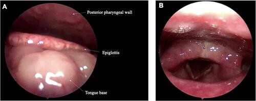 Figure 1 The endoscopic findings from patient 11. (A) The image demonstrates a swollen base of the tongue, pushing the epiglottis toward the posterior pharyngeal wall. (B) Arytenoid mucosal edema. Vocal folds and other areas appear normal.