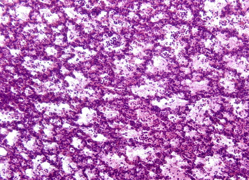 Figure 6. Intense inflammatory reaction, lung lobe, ovine. Neutrophilic infiltrate within bronchioles and alveoli. H&E stain; bar = 100 μm.