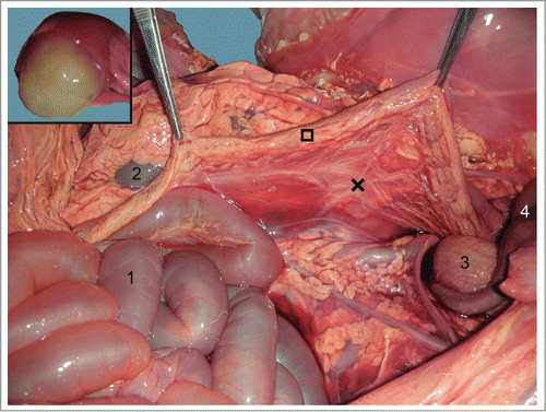 Figure 6. Descending colon (□) suspended by the mesocolon (×). 1) Jejunum; 2) Left kidney; 3) urine bladder; 4) Umbilical arteries. Inset: yellowish mucous secretion filling the descending colon lumen.