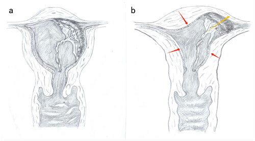 Figure 4. We speculated about the reasons for retained placenta in our study. a) showed that the placental implantation site in upper-lateral angle of uterine cavity after birth of the infant. b) showed placental spatial relations after birth. The placenta was forced to protrude into upper-lateral angle of uterine cavity after the uterus spontaneously contracted.