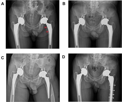 Figure 1 Pelvis AP radiograph of 41-year-old patient suffered from stem loosening of primary THA, s/p periprosthetic fracture 2 years after the first RTHA with primary stem and receiving second RTHA. (A) Aseptic loosening of left femoral stem, the arrow shows the subsidence of stem and radiolucency around prosthesis before the first RTHA. (B) Immediate postoperative radiograph of the first RTHA using primary stem, which was ML taper stem from size 12.5mm changed to size 15mm. (C) Periprosthetic fracture (Vancouver type B2) occurred 2 years after the first RTHA surgery. (D) Second RTHA using cementless full-porous-coated long stem and multiple wiring fixation.