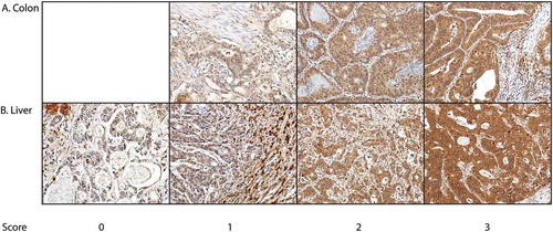 Figure 4. Immunohistochemical staining of TKTL1 in (a) primary CRC tumors and (b) liver metastases. Samples were scored for cytoplasmic intensity on a four-grade scale as follows: 0) negative, 1) mild, 2) moderate, and 3) strong. Original magnification at 400x.
