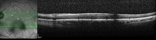 Figure 3 OCT B Scan of a symptomatic patient. The vitreous opacities seen in the IR image on the right of the figure cast a shadow on the scans of the retina.