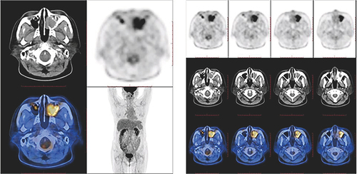 Figure 2 PET/CT image of the soft tissue shadow with increased SUV in the left maxillary sinus.