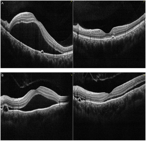 Figure 5. Examples of the change in pigment epithelial detachment (PED) with spectral domain optical coherence tomography (SD-OCT) in patients with chronic central serous chorioretinopathy (cCSC) after subthreshold micropulse laser (SML). The left panel represents SD-OCT B-scan images at baseline visit, the right panel represents SD-OCT B-scan images at one-month follow-up visit after SML. (A) SD-OCT B-scan at baseline showed sub-macular SRF and a small PED from the left eye of a 41-year-old male patient (left). SRF was completely absorbed, small PED remained visible with a discontinuous ellipsoid zone at one-month visit (right). (B) SD-OCT B-scan at baseline showed sub-macular SRF and a dome-shaped PED from the left eye of a 48-year-old female patient (left). At the one-month visit, SRF as well as PED were partially resolved (right).