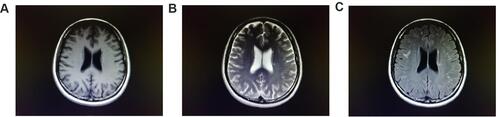 Figure 2 A 39-year-old female, with multiple dots and patches of long T1 (A) and long T2 signals (B) in the cerebral lobes near bilateral ventricles, and high fluid-attenuated inversion recovery signals (C), reported “white matter demyelinating degeneration, multiple sclerosis” by magnetic resonance imaging, clinically diagnosed as “anxiety and depression,” and a history of carbon monoxide poisoning.