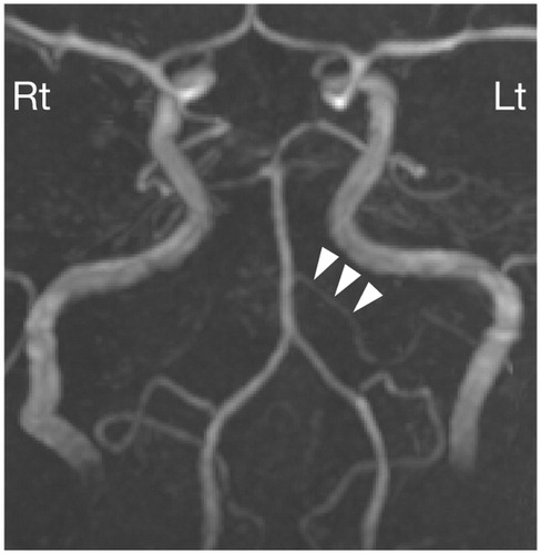 Figure 2. MR angiography. MR angiography shows the normal appearance of the vertebrobasilar artery. The anterior inferior cerebral artery (AICA; arrowheads) is visualized on the left side. The lack of visualization of the AICA does not necessarily imply occlusion of the vessel.