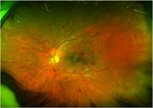 Figure 6 Widefield view of fundus suggestive of severe NPDR. Note the ability to visualize lesions beyond the standard 7-field photograph. Peripherals lesions are effectively seen.