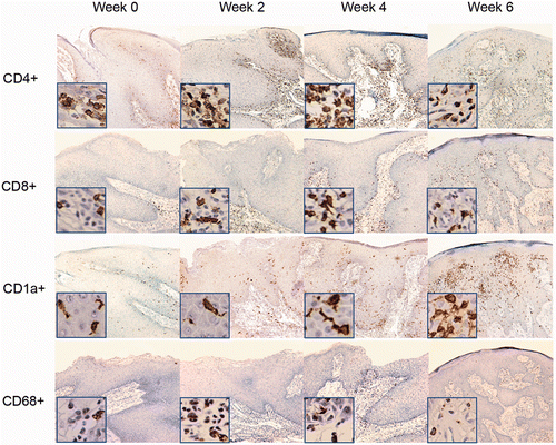 Figure 2. Immunohistochemical staining for CD4, CD8, CD1a and CD68 cells in untreated lesions distant from the target lesions (10×).Thumbnails were taken from the same picture (40×).