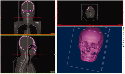 Figure 3. Delete the unwanted part of the model. We select Menu bar > Segment > Edit Mask in 3 D and use the “Lasso” to choose the unrequired parts, such as the vertebra. Then, we select “Remove” to delete it.