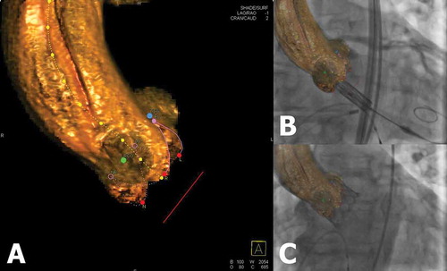 Figure 2. Hybrid imaging during TAVI. (A) 3D reconstructed DynaCT of the aortic root using Aortic Valve Guide (Siemens Healthineers) shows automatically generated aortic centerline (marked yellow dotted line), a circle of perpendicularity (marked red line), and coronary ostia markers (blue and green markers). (B, C) The cusps markers (red dots) and circle of perpendicularity enable accurate prosthesis deployment at the correct annular height