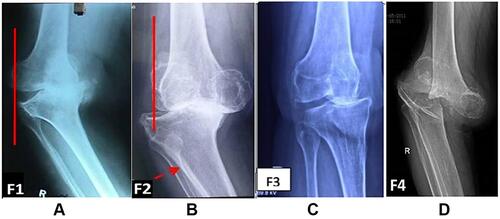 Figure 1 Categorization of radiographs as per our defined guidelines. (A) F1 - Varus with angulation. A line drawn from lateral most part of lateral femoral condyle does not transect the tibia. (B) F2 - Varus with subluxation and torsion a line drawn from lateral femoral condyle transects the tibia with evidence of compromise of the interosseous space (arrow). (C) F3 - Medial translation of tibia relative to femur. (D) F4 – Varus deformity with major bone loss.