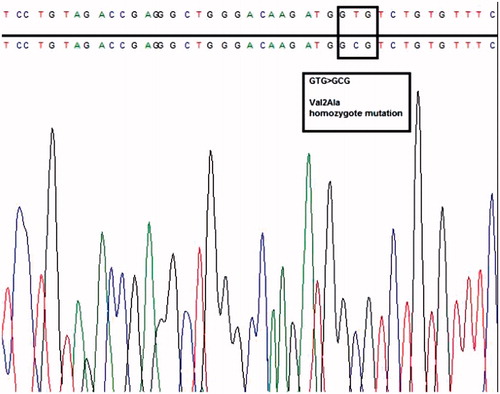 Figure 2. Val2Ala homozygote mutation in the fifth nucleotide position of ATP6V0A4 gene.