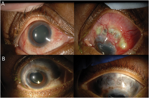 Figure 3. Photographs of patient with a history of granulomatosis with polyangiitis. A) Slit lamp photos demonstrating treatment-refractory bilateral anterior diffuse and necrotizing scleritis associated with bilateral cataract and panuveitis. B) Slit lamp photos at 43 months demonstrating extensive bilateral scleromalacia despite multiple treatments.