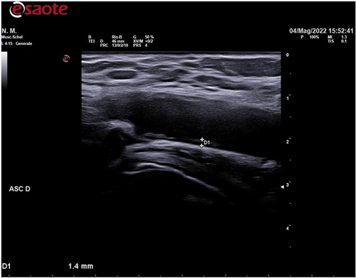 Figure 2 Axillary artery intima media thickening of a patient treated with MTX and suffering from minor relapse.