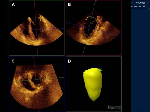 Figure 1 Measurement of left ventricular (LV) end-diastolic volume (EDV).